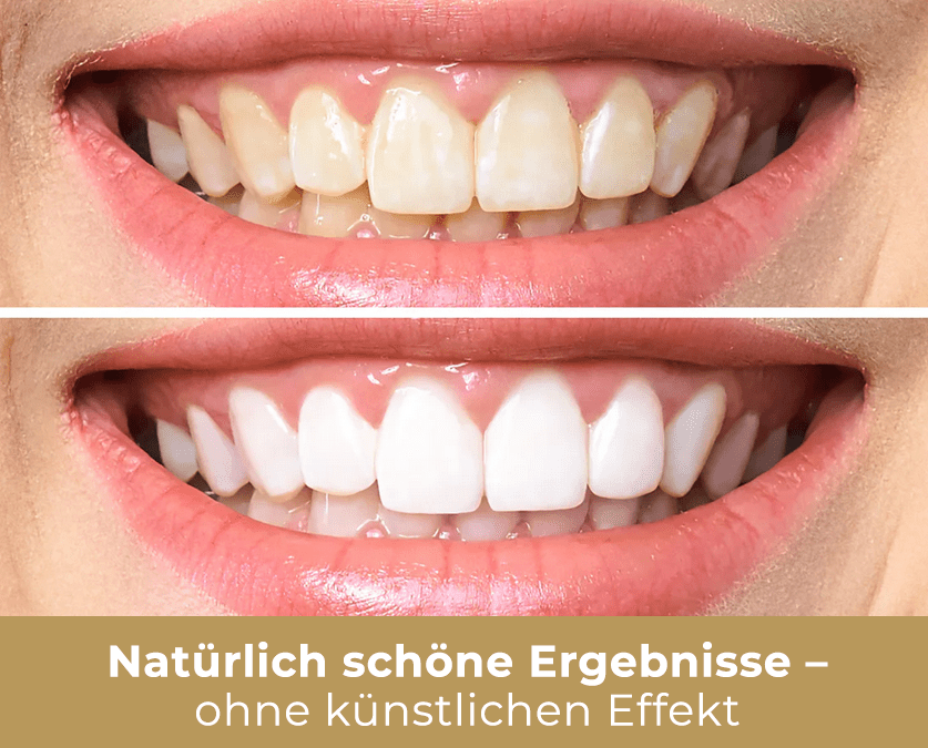 Deine Expertin für Kosmetik 1 zahnbleachin voerde dinslaken duisburg zahnaufhellung professionell